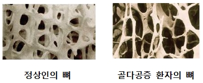골다곤증11 골다곤증11