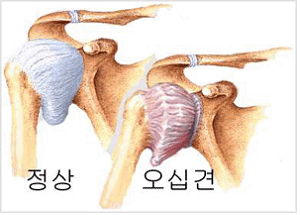 오십견 오십견