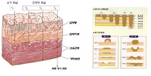 위암2 위암2