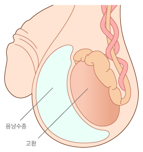 음낭수종1