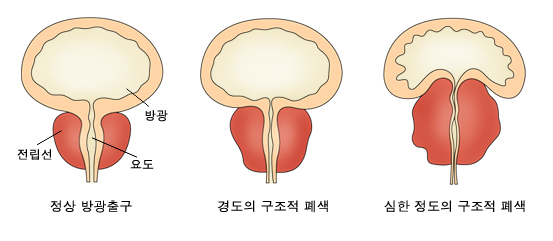 전립선비대증1 전립선비대증1