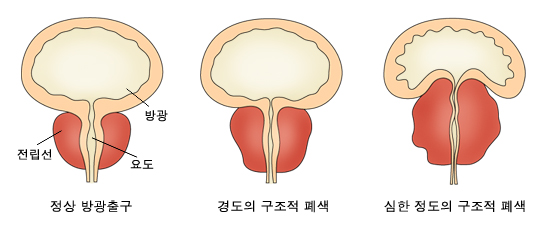 전립선비대증1