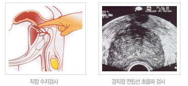 전립선비대증2