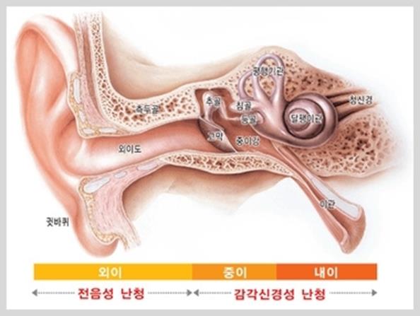 난청2