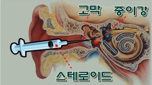 돌발성난청2 돌발성난청2