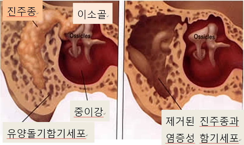 만성중이염4 만성중이염4