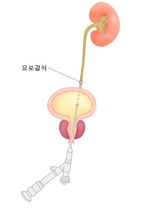 요로결석2