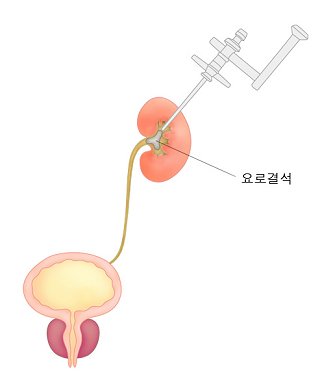 요로결석3